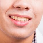 Sarro dental: Qué es y cómo prevenirlo