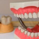 Prótesis dentales