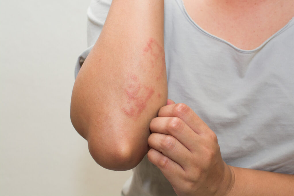 Dermatitis por calor: cómo identificarla y prevenirla