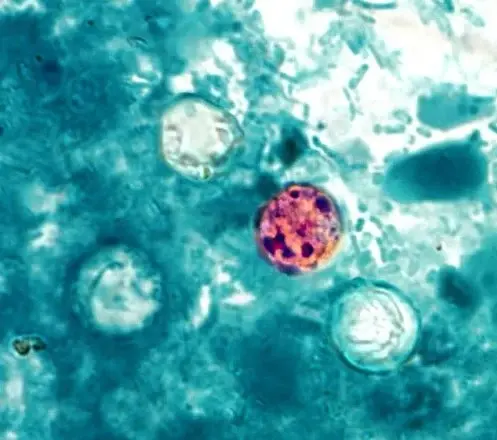 Parásito Ciclosporiasis: Aumentan casos de diarrea grave en NYC y otros estados