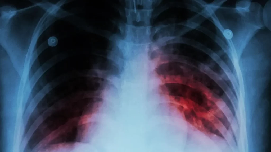 Tuberculosis latente: qué significa, por qué no contagia y cuándo puede convertirse en enfermedad activa